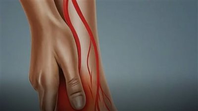 انسداد شرايين القدم.. أعراض مبكرة قد تنذر بمشكلة في الدورة الدموية