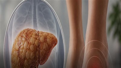 تظهر على القدمين.. إليك أعراض الإصابة بالكبد الدهني