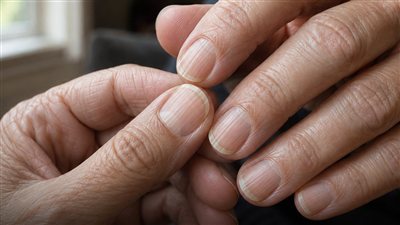 انتبه لأظافرك.. 4 تغيرات قد تظهر مع نقص الحديد في الجسم ! 