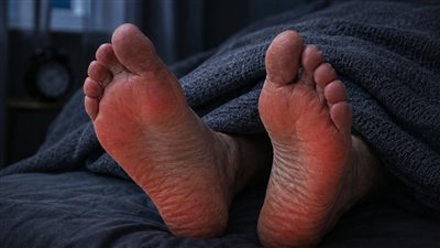 حرقة القدمين أثناء الليل.. لماذا تزداد عند النوم وكيف يمكن التعامل معها؟