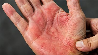 انتبه لراحة يديك.. 4 تغيرات تكشف ضعف الكبد لا تتجاهلها ! 