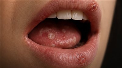 ضعف المناعة يظهر في الفم.. 4 تغيرات متكررة انتبه إليها