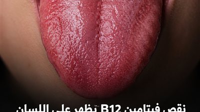 نقص فيتامين B12 يظهر على اللسان.. 5 تغيرات واضحة لا تتجاهلها