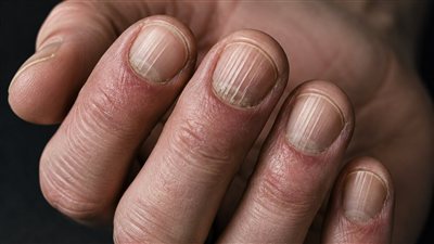 نقص فيتامين B12 يظهر في اليدين.. 4 تغيرات غير متوقعة انتبه إليها