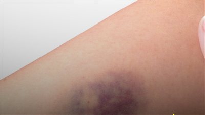 ظهور كدمات دون ضربة.. 5 مشكلات من الدم إلى الكبد لا تتجاهلها