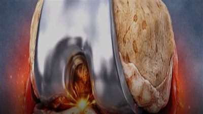 عدم شفاء خشونة الركبة رغم العلاج- حسام موافي يوضح السبب