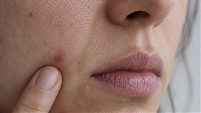 شكل نقص فيتامين B12 على الوجه.. أعراض تظهر عليه احذرها