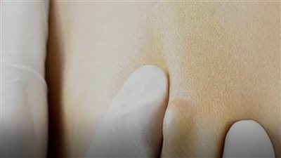 ظهور كتل صلبة تحت الجلد.. متى تكون طبيعية ومتى تستدعي القلق؟