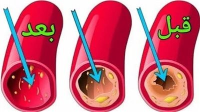 طبيب قلب طعام واحد في العشاء ينظّف الشرايين كالمكنسة ويمنع الجلطات فورًا