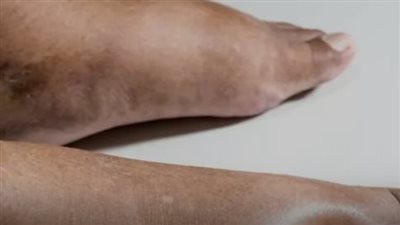 قَدم السكري من أكثر المشاكل الشائعة لدى مرضى السكري