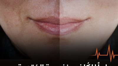وداعاً للكلف ونفسية المُتعبة  الحل مستخلص من عشبة وحدة تعرف عليها
