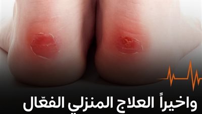  واخيراً العلاج المنزلي الفعّال  لهذه الحالة الي تحدث بسبب الحذاء 