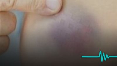 حذّر الدكتور حسام موافي، أستاذ طب الحالات الحرجة بكلية طب قصر العيني، من إهمال ظهور البقع الزرقاء على الجلد.. 