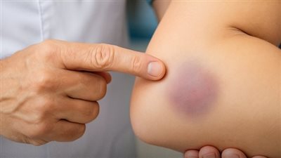 انتبه لجلدك  5 بقع غريبة قد تكون إنذارًا مبكرًا لأمراض داخلية ! 