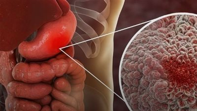 أعراض سرطان القولون لدى النساء – علامات يجب الانتباه لها ! 