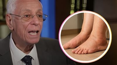 تورّم القدمين  الأسباب والمخاطر الصحية كما يوضّحها الدكتور موافي ! 