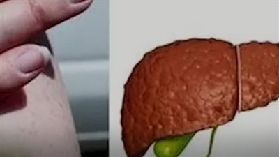 ما هي علامات مرض الكبد على الجلد؟ إشارات تظهر على بشرتك قد تدل على تليف الكبد دون أن تشعر ! 