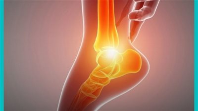 حړقة القدم عرض شائع يسبب الإزعاج للكثيرين ويرتبط بعدة أسباب صحية مختلفة  اكتشف أبرزها معنا ! 