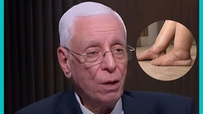 انتبه إذا كانت قدماك تتورمان! د. حسام موافي يوضح الأسباب والمضاعفات المحتملة.. تعرف عليها ! 