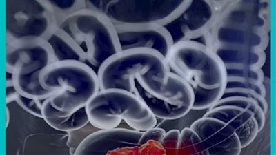 لا تتجاهلها! 4 أعراض شائعة قد تكون علامة خطيرة على سرطان القولون وتستدعي زيارة الطبيب فورًا ! 