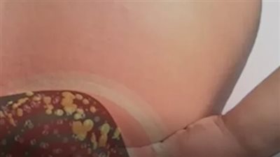 كيف يكون وجع الكبد الدهني؟