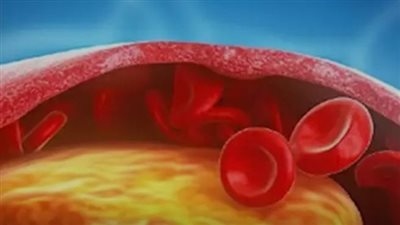 هناك وجبة تتكوّن من 3 أطعمة يمكن الاعتماد عليها لخفض الكوليسترول الضار في الدم