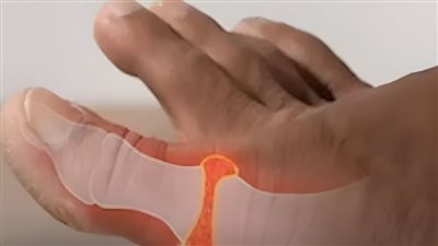ما هو علاج ارتفاع حمض اليوريك؟ يمكن تقليل مستوياته بصورة طبيعية باتباع إرشادات بسيطة ! 