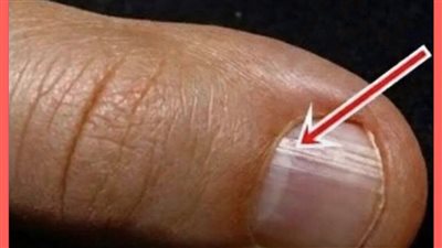 ماذا تعني الخطوط على الأظافر وأسباب ظهورها؟